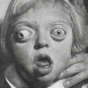image: Patient with Crouzon syndrome (photo from classic Crouzon's paper)