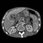 CT scan showing cholangiocarcinoma