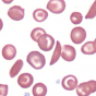 Blood smear illustrating sickle cell anaemia. Source: Scooter Project